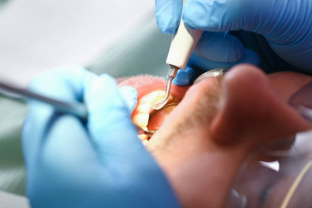 Best Emergency Treatment for Dental Infections or Abscesses in Granite Falls, WA